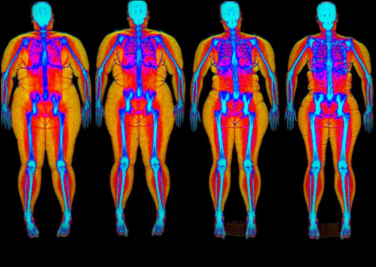 Body Composition Improvement Body DEXA Fit Melbourne DEXA scans